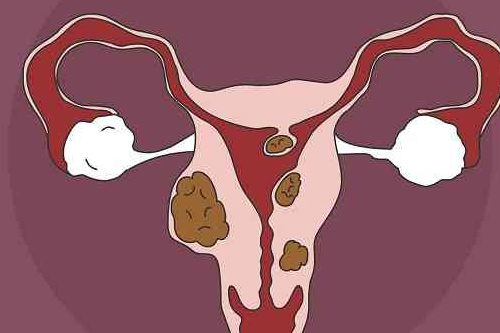 快速了解什么是子宫内膜炎